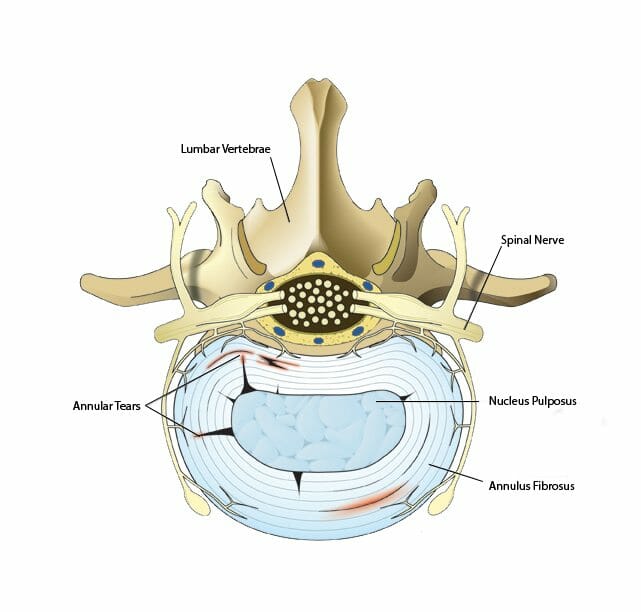 Autologous Stem Cell Injections for Back Pain: Can They Help?