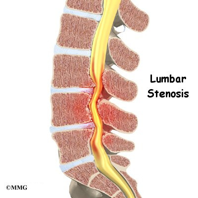 PRP Therapy for Spinal Stenosis: What to Expect